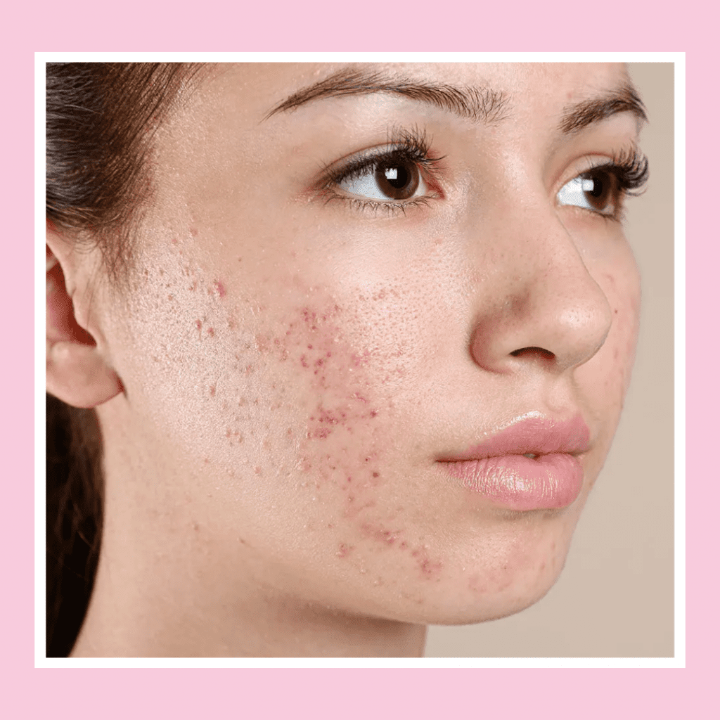 Acne Treatment London Clear Skin Solutions