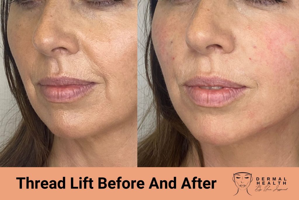 thread lift before and after