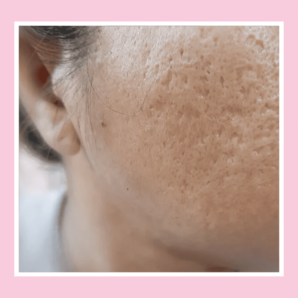 acne scars treatment london (2)