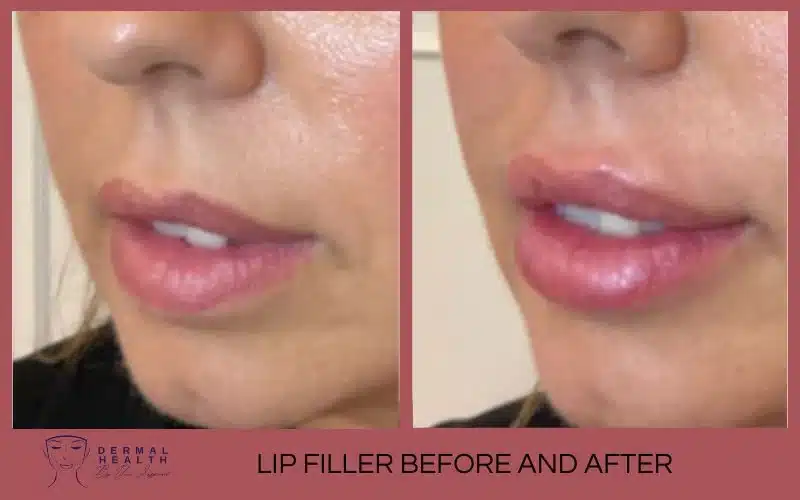 lip filler before and after