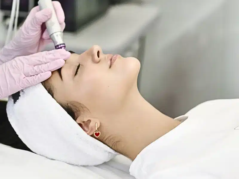microdermabrasion treatments