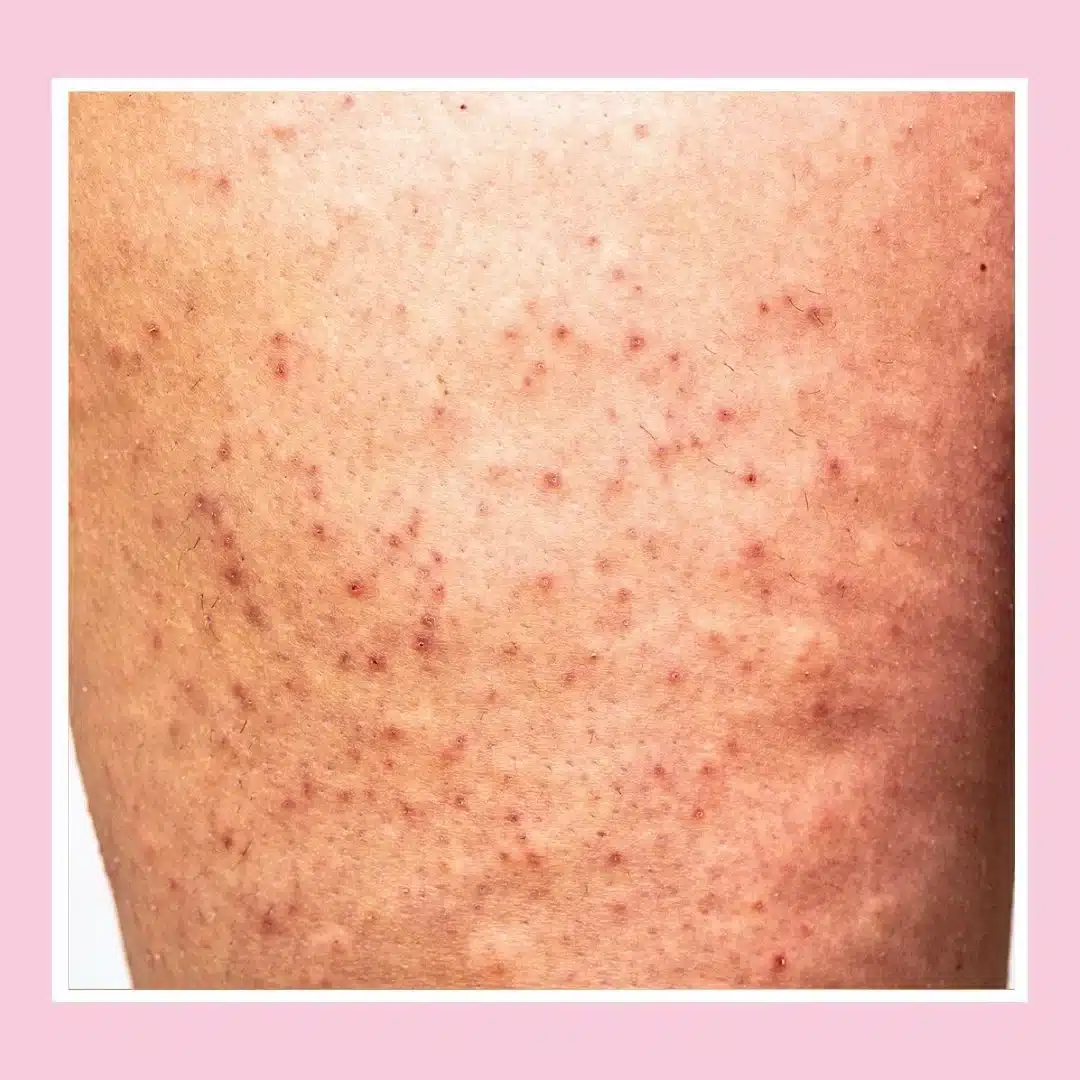 keratosis pilaris.