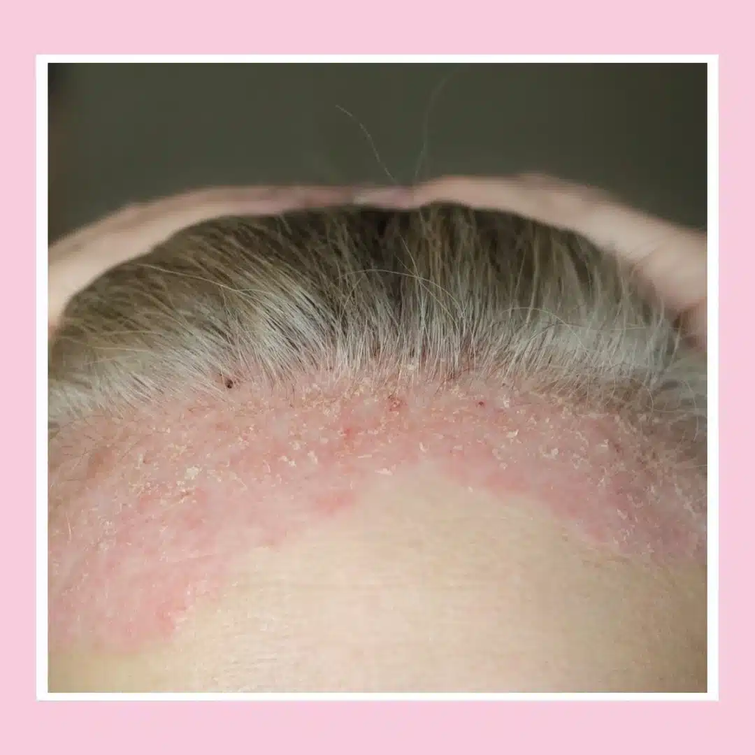 psoriasis