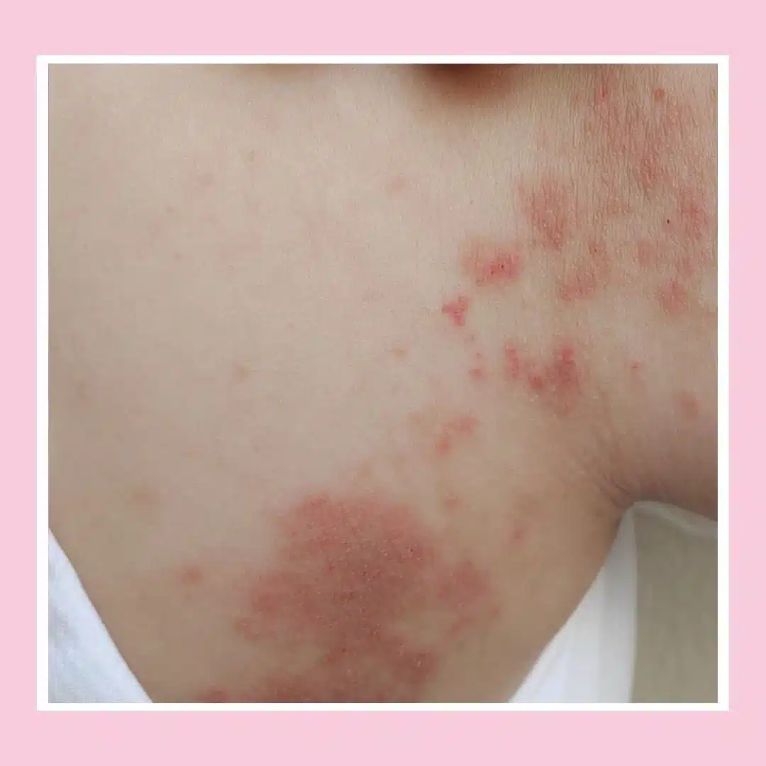 impetigo.