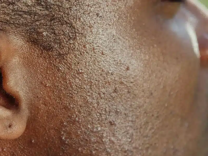 folliculitis pic