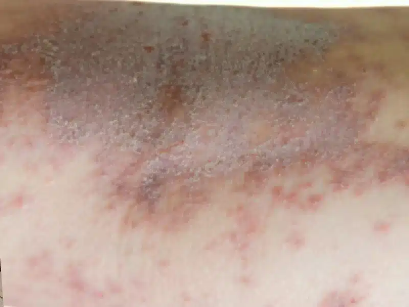 eczema picture