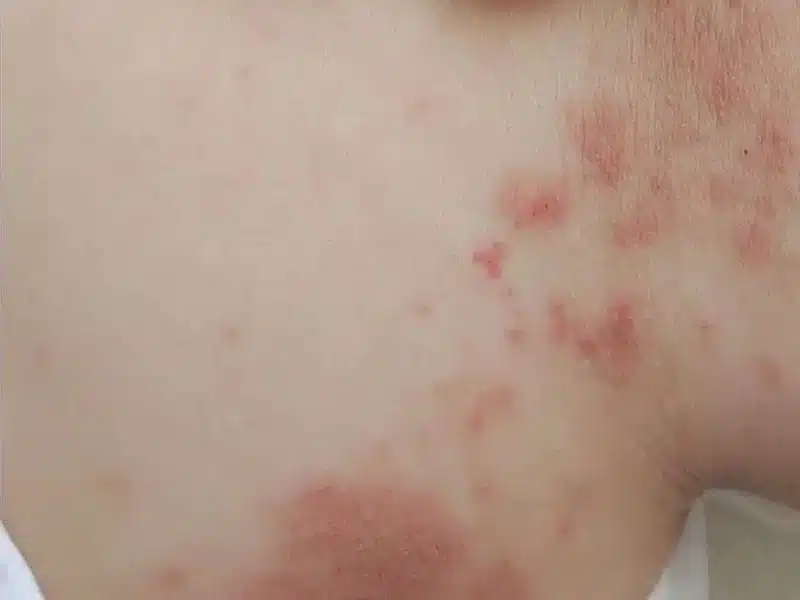 impetigo picture