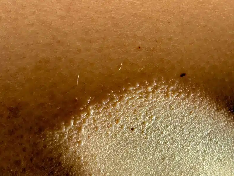 keratosis pilaris picture