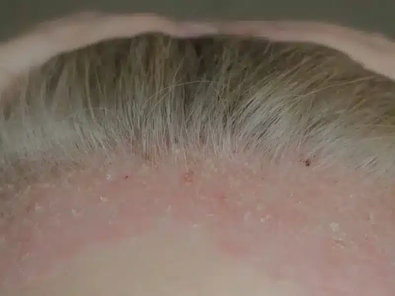 psoriasis picture